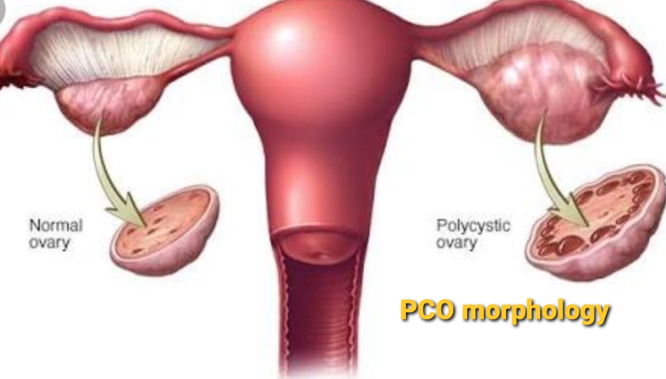 pcos